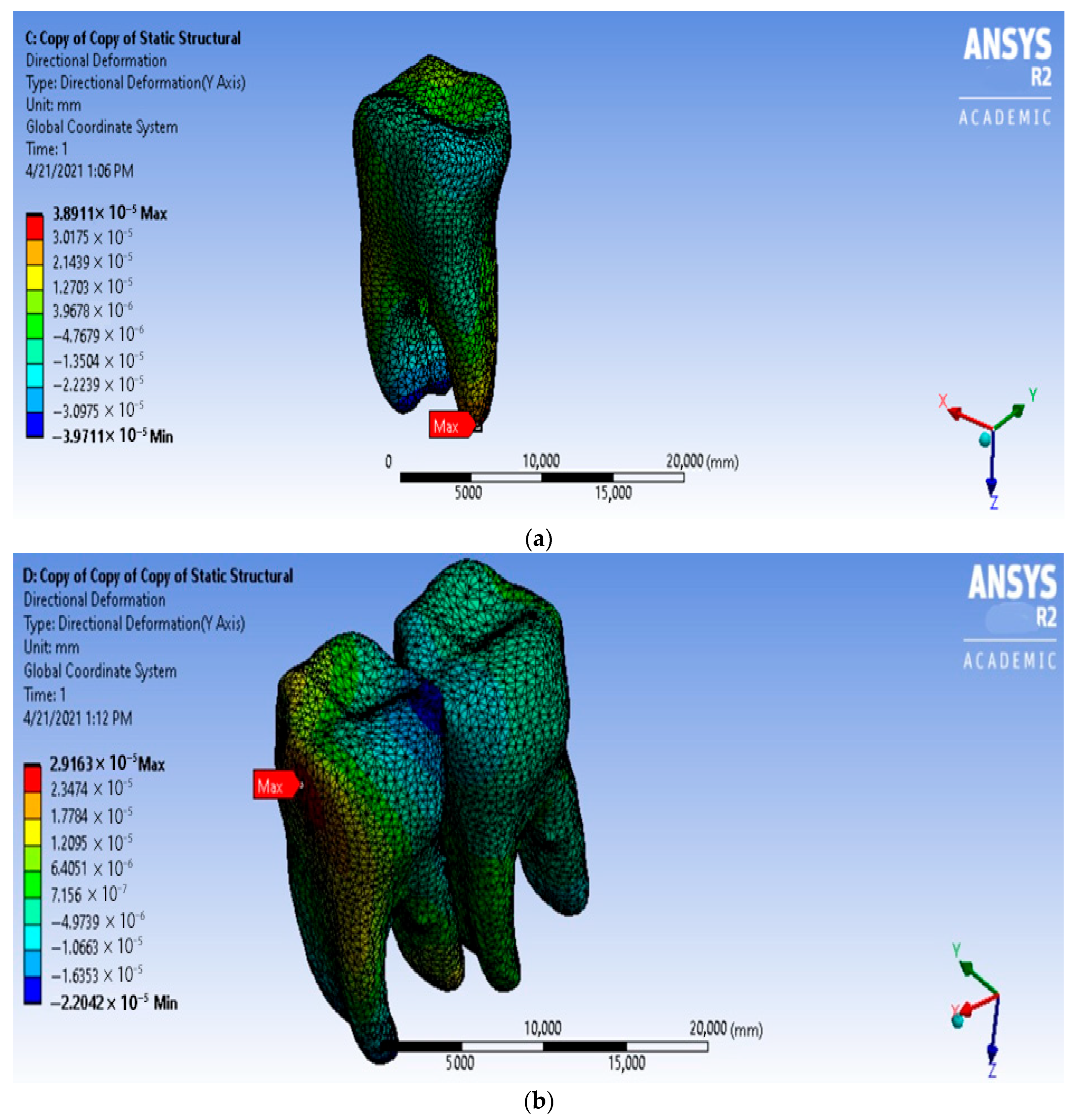 Biomechanical Evaluation of the Second Molar Uprighting with Retromolar ...