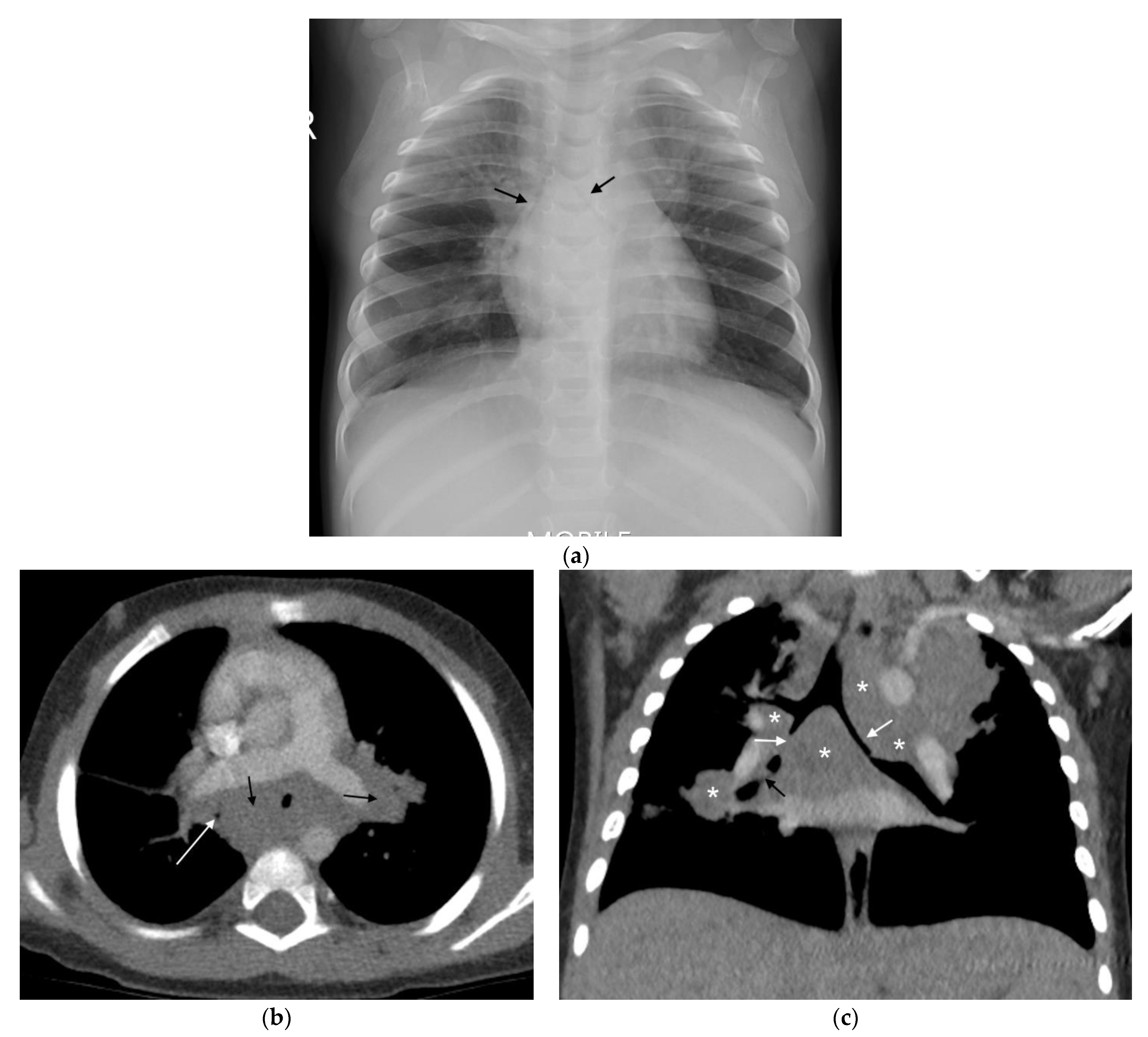CT findings of pulmonary cysts