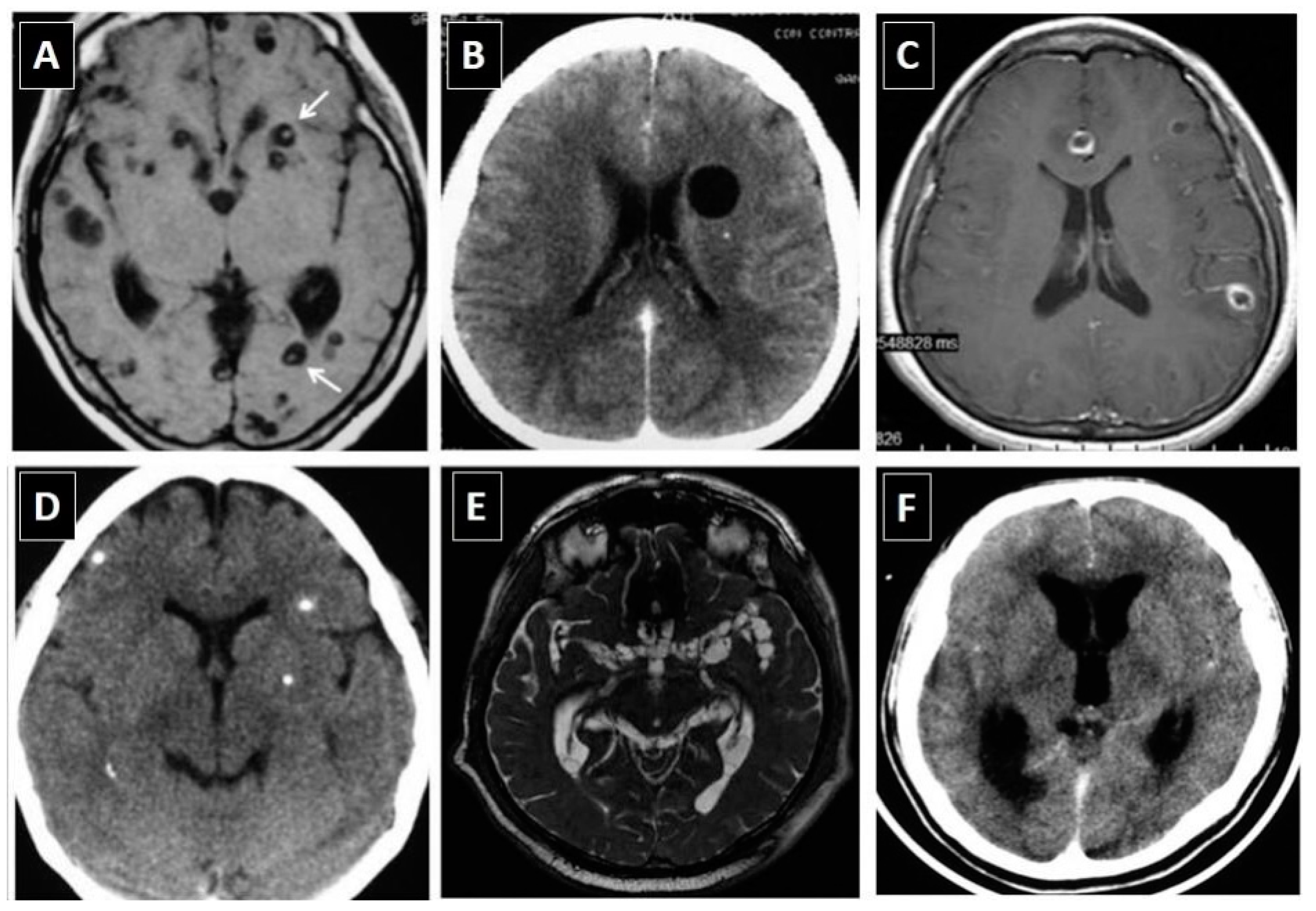 neurocysticercosis