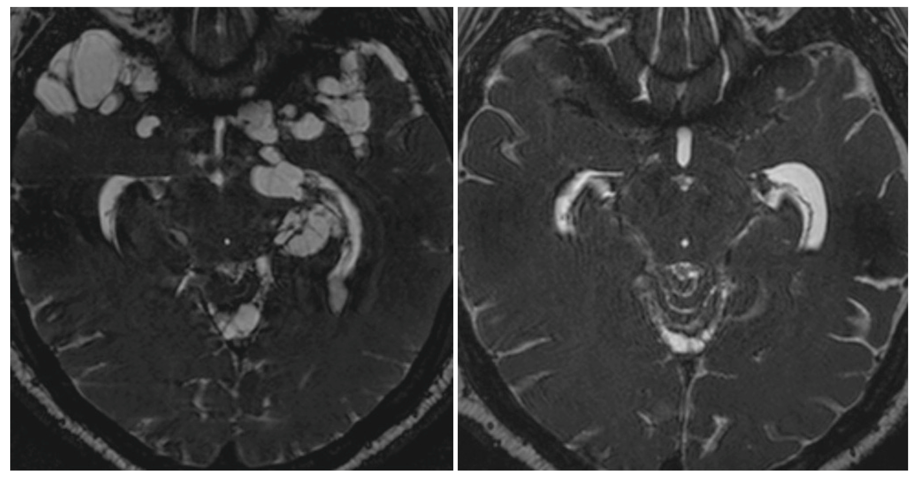 neurocysticercosis