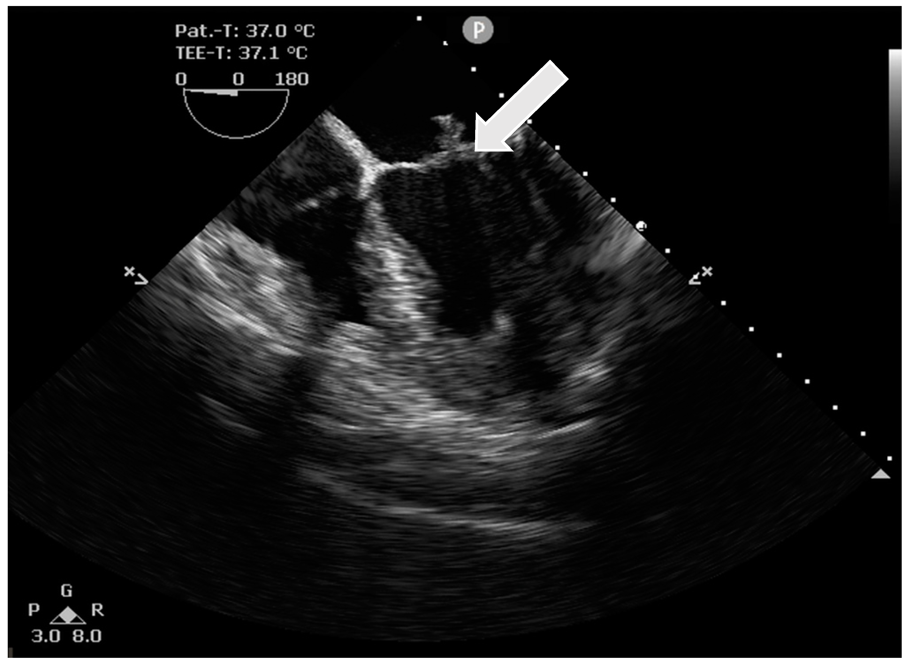 Pathogens | Free Full-Text | A Dual-Pathogen Mitral Valve