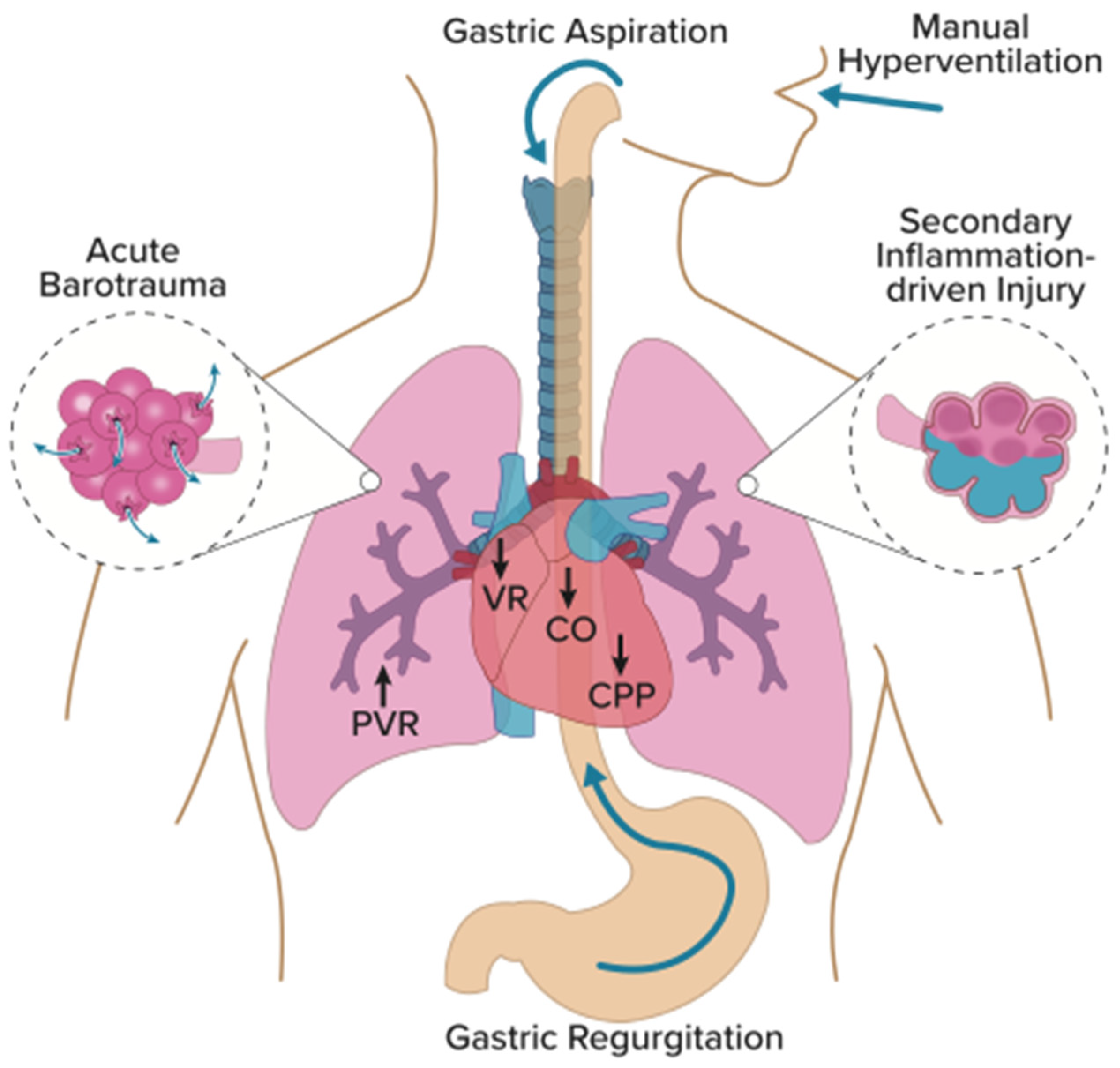 Pathophysiology And Prevention Of Manual Ventilation Induced Lung Pathophysiology And Prevention Of Manual Ventilation Induced Lung