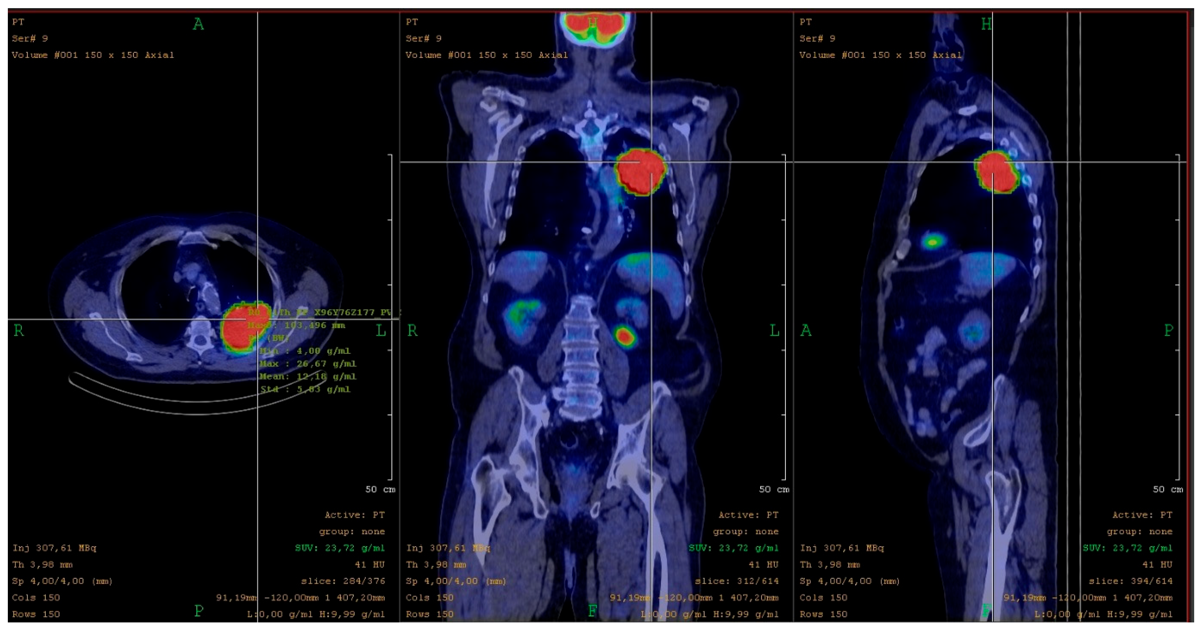 Tumor Characterization Using [18F]FDG PET Radiomics in a PD-L1-Positive ...