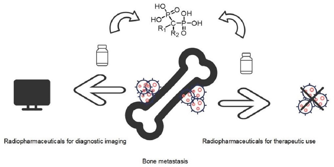 Theranostics of Bone Metastases: The Role and Prospects of ...