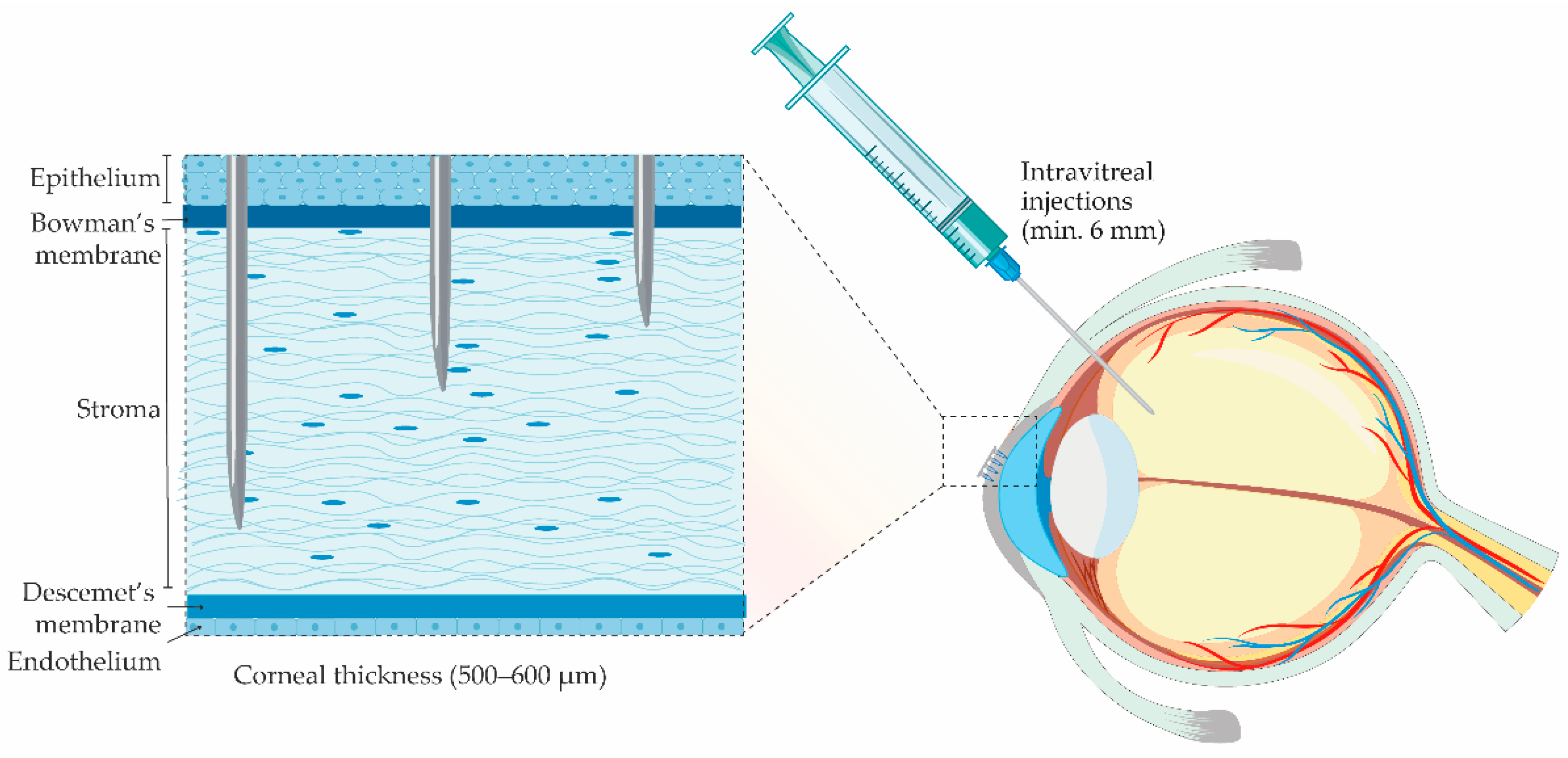 Fix IOP according to corneal thickness - Dr. Alex Giménez - 1