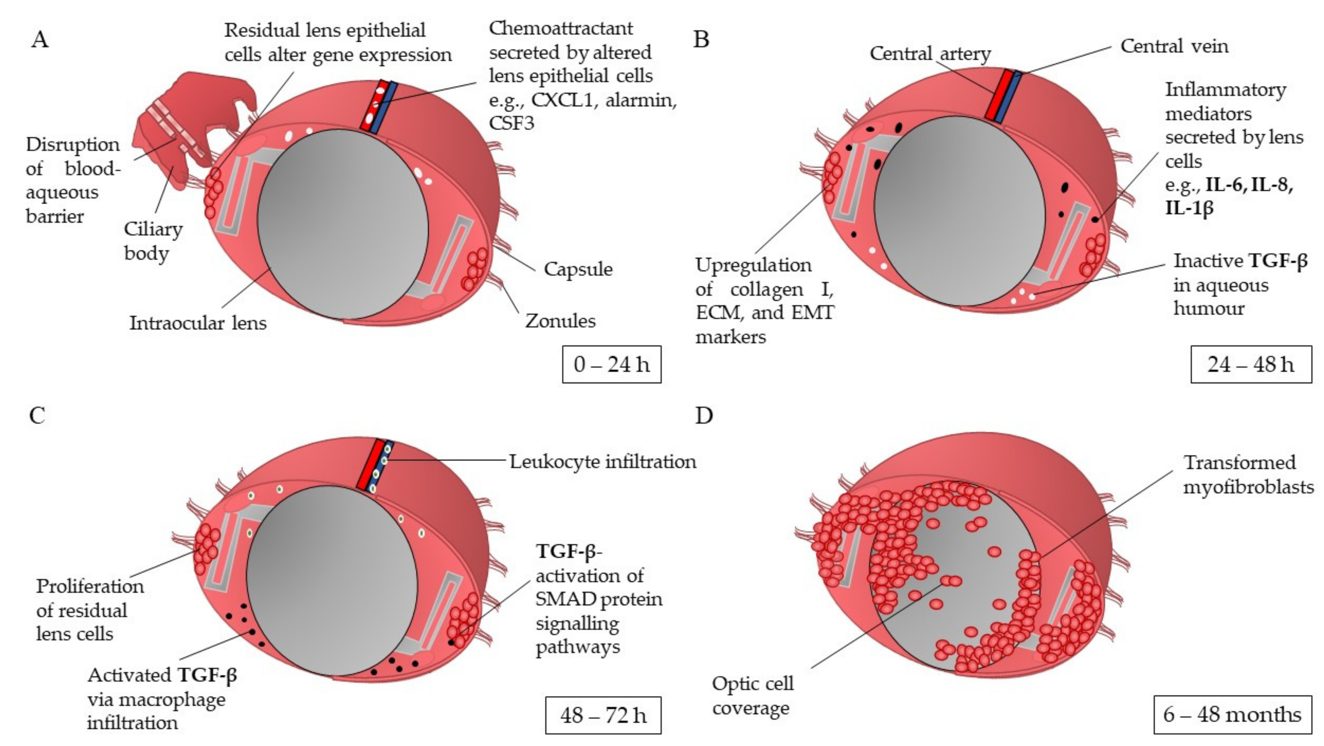 Sulcus-fixed capsular bag intraocular lens | Download Scientific Diagram