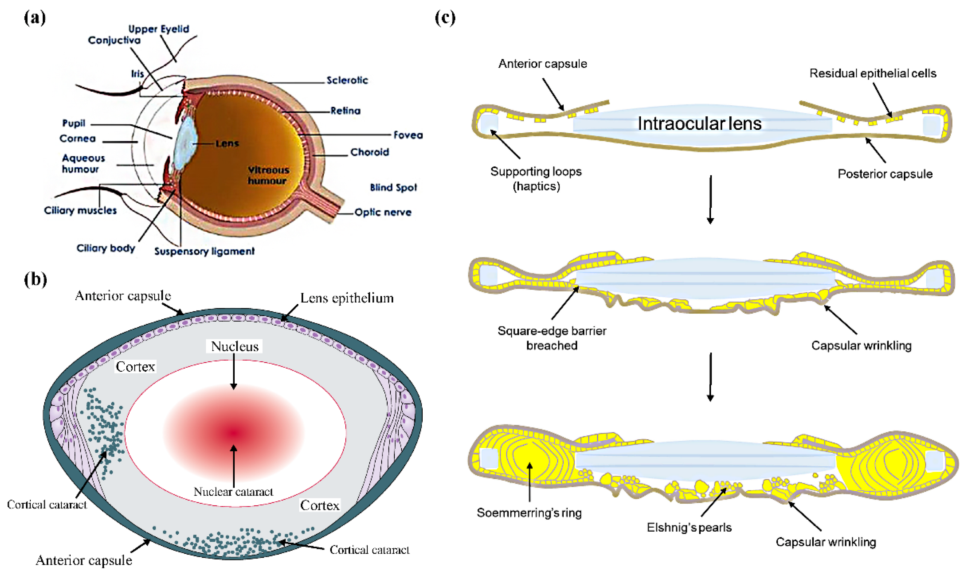 An improved two-steps method for secondary in-the-bag intraocular lens  implantation in aphakia eye - Xiaomeng Li, Dawei Luo, Chufeng Gu, Thashi  Lhamo, Deji Draga, Zhi Zheng, Qinghua Qiu, 2023