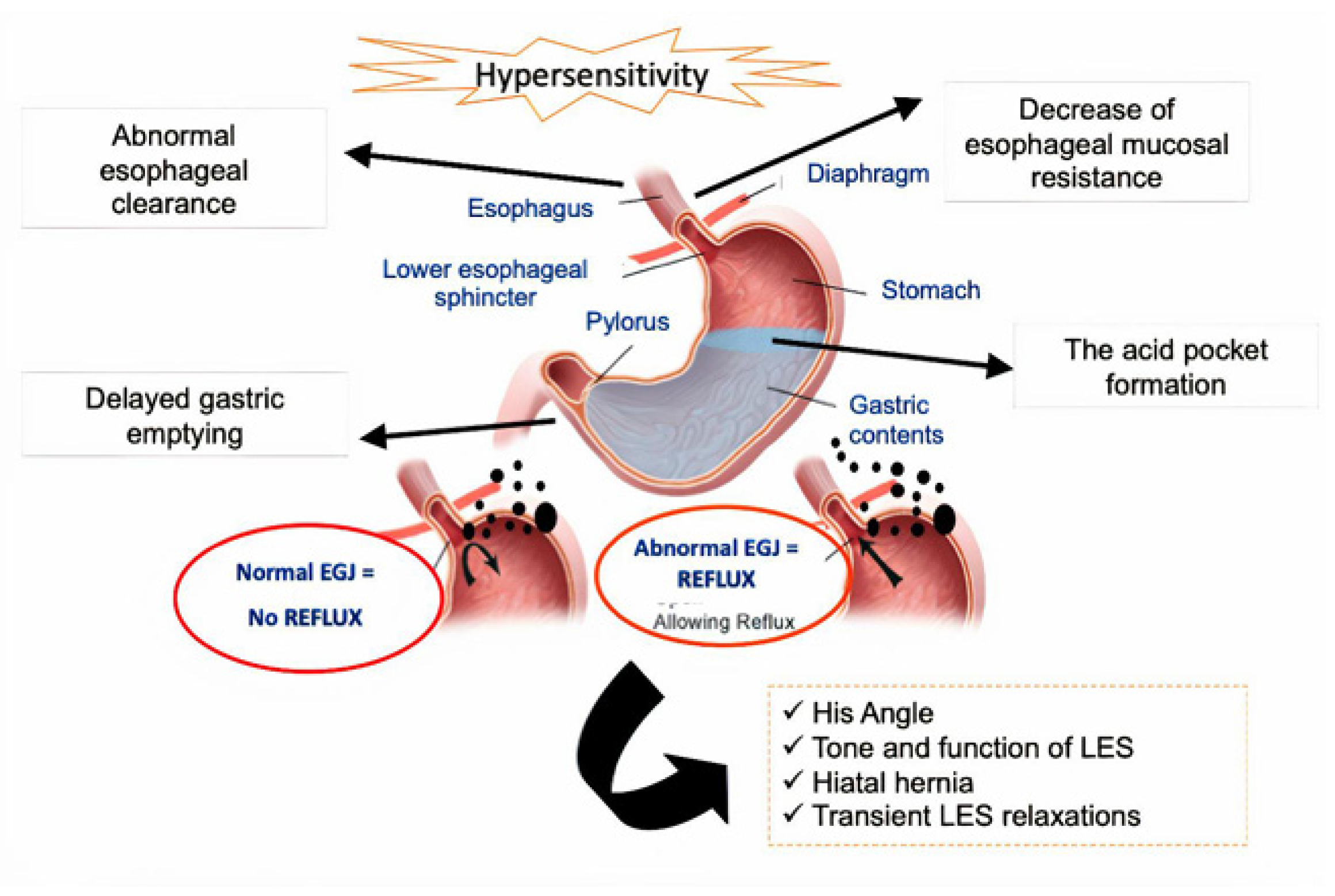 Can Coffee Cause Gastroesophageal Reflux Disease At Elaine Osborn Blog Can Coffee Cause Gastroesophageal Reflux Disease At Elaine Osborn Blog