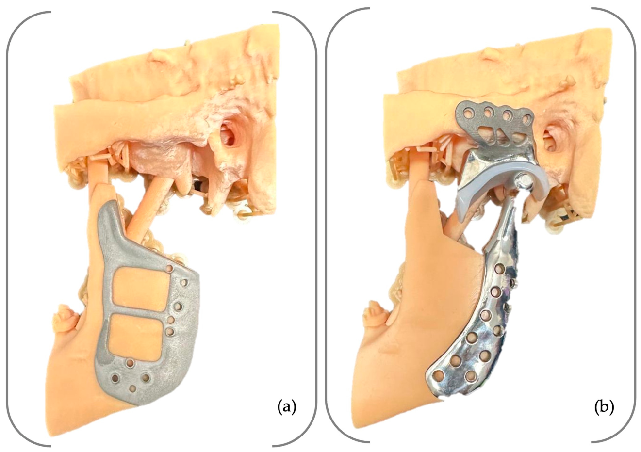 Total Prothesis From Digital Planning to Personalised Surgical Integration: Total ...