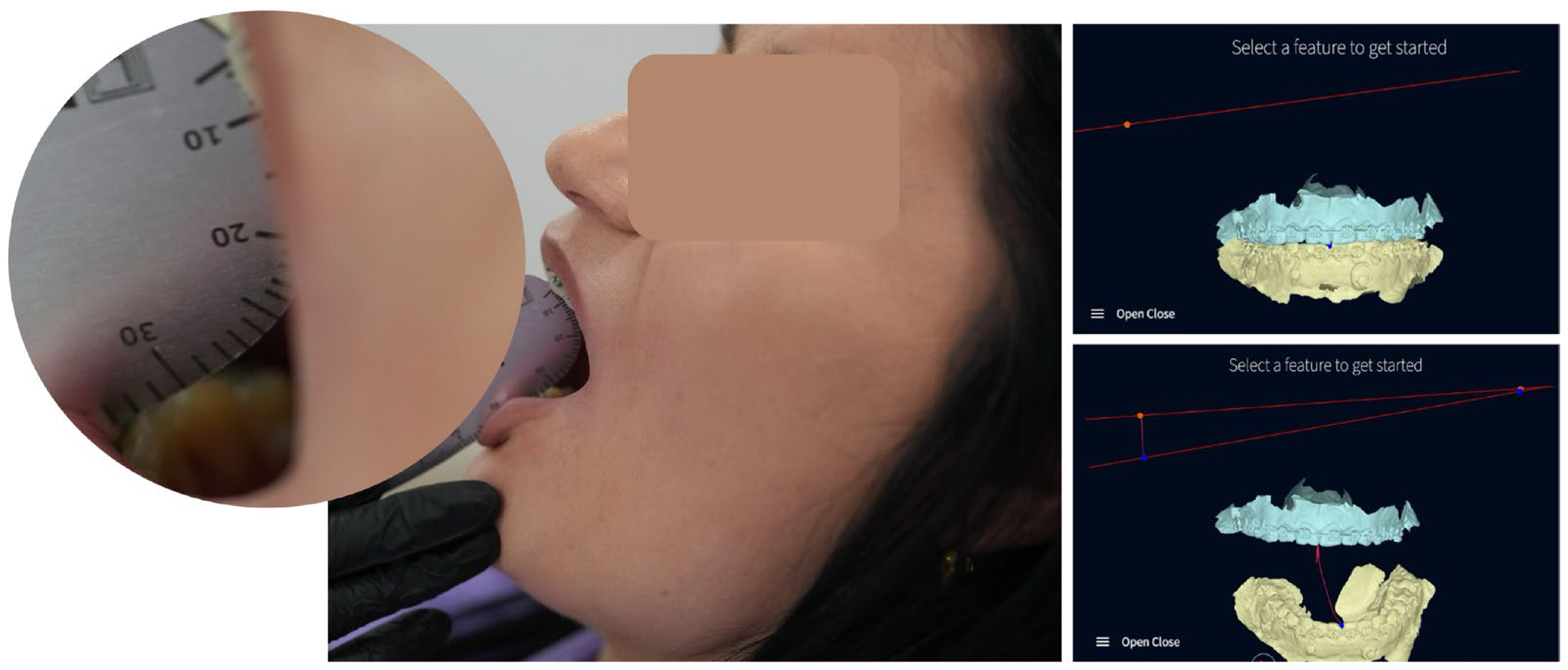 Total Prothesis From Digital Planning to Personalised Surgical Integration: Total ...