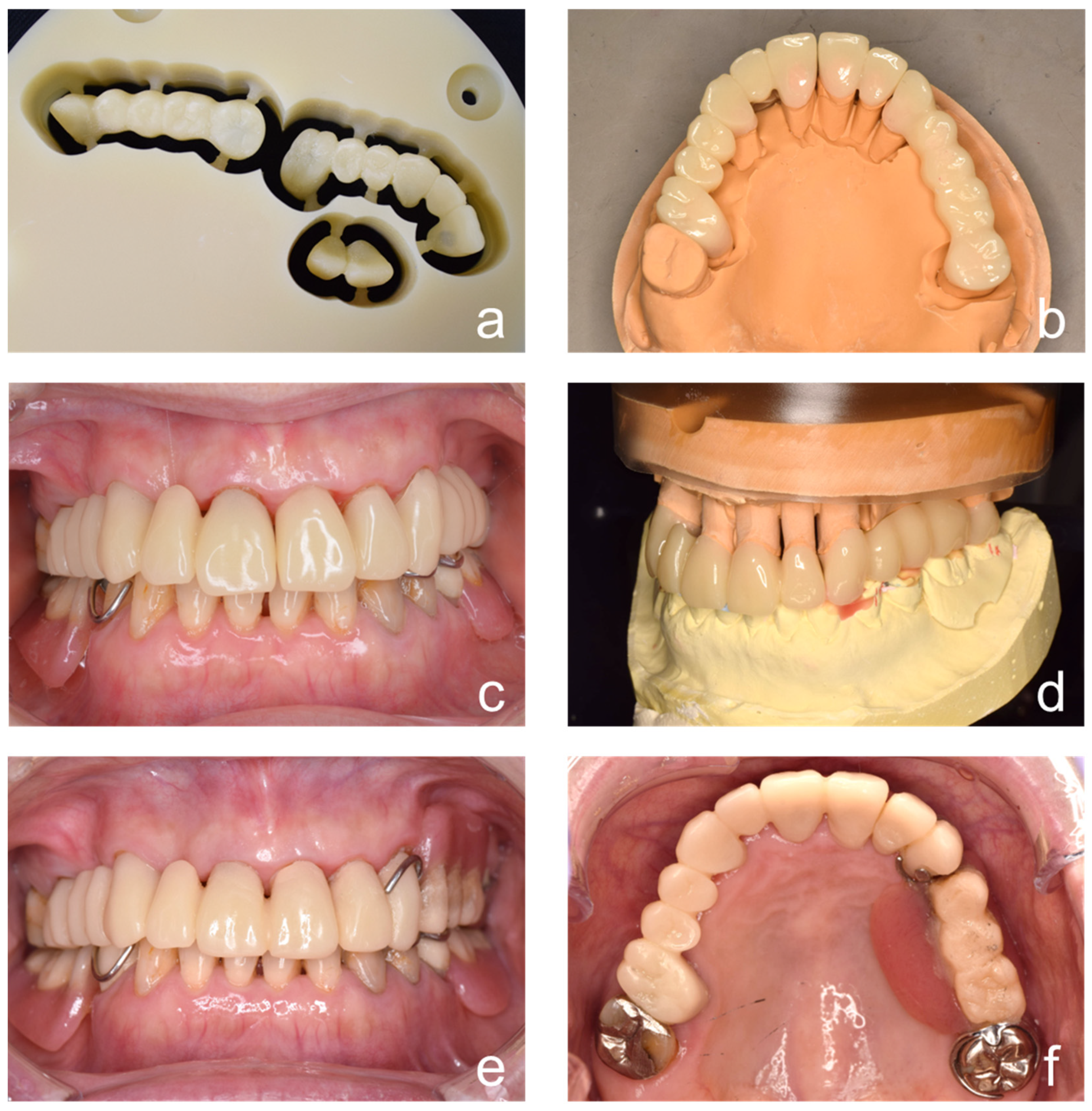 CAD–CAM-Fabricated Provisional Restoration for Bite Registration in ...