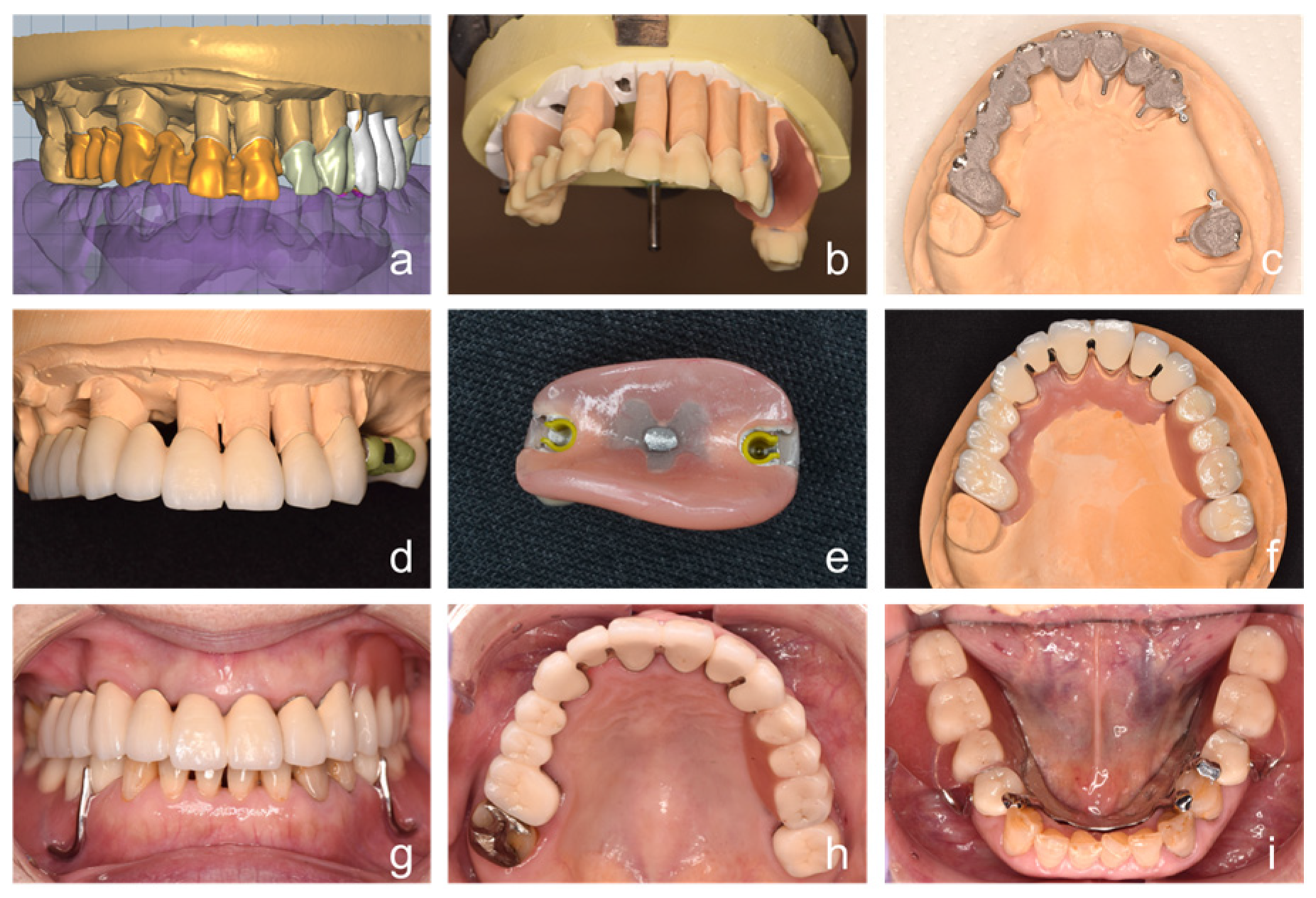 CAD–CAM-Fabricated Provisional Restoration for Bite Registration in ...