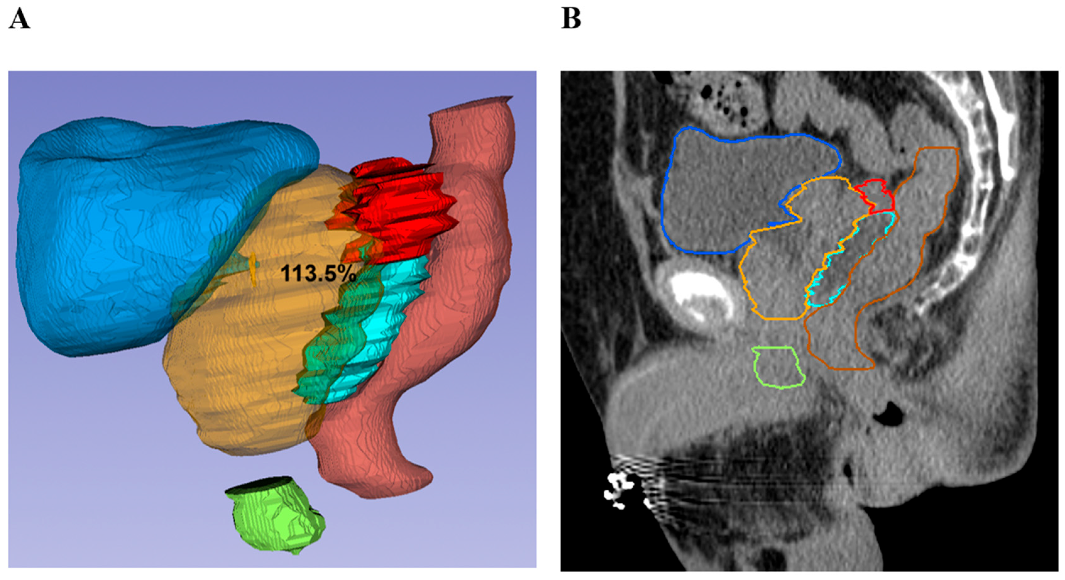 Prostate–Rectum Spacing from Apex to Base and Its Impact on Organs-At ...
