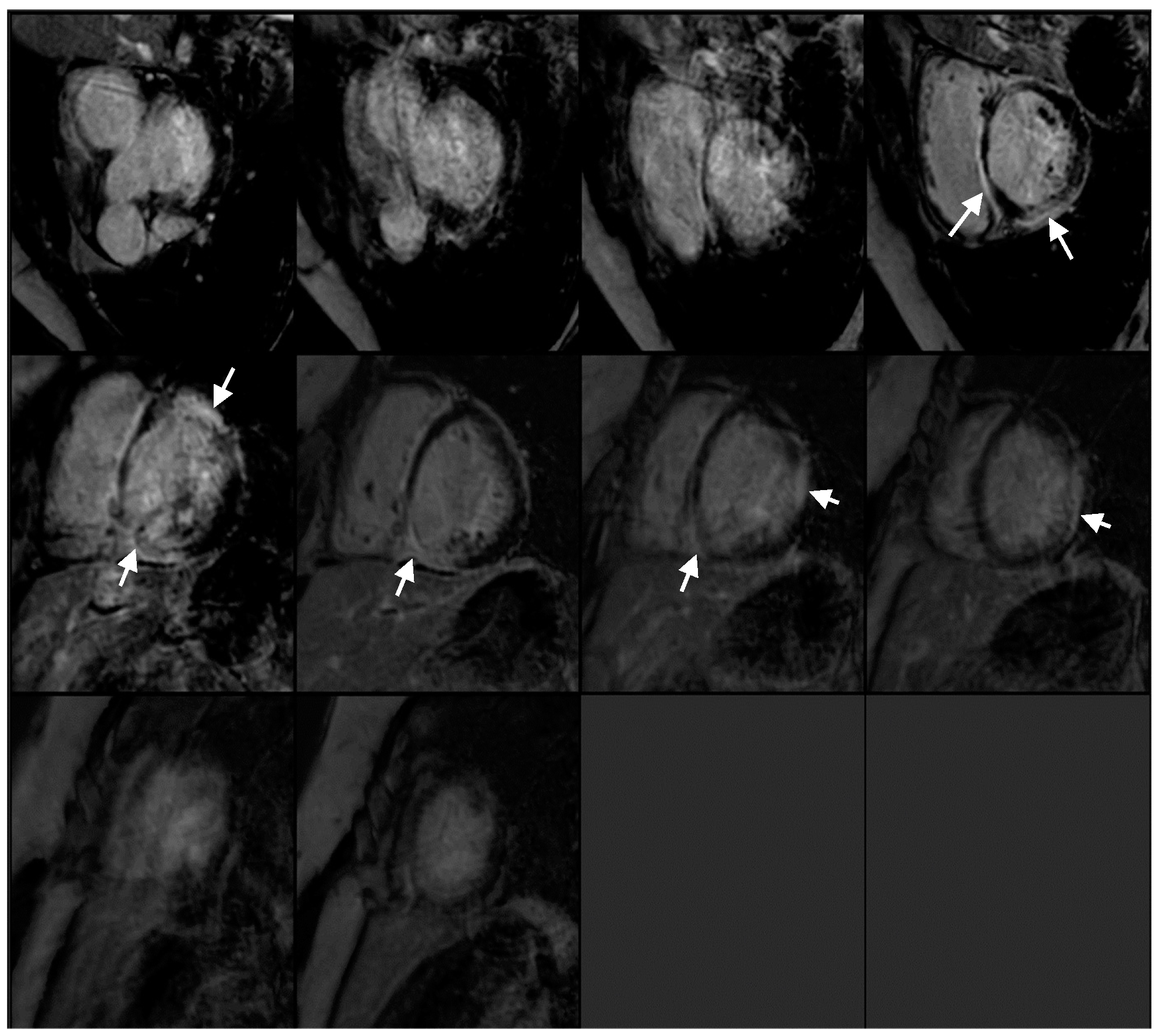 A Case Report: The Utility of Multimodality Imaging in the Diagnosis of ...