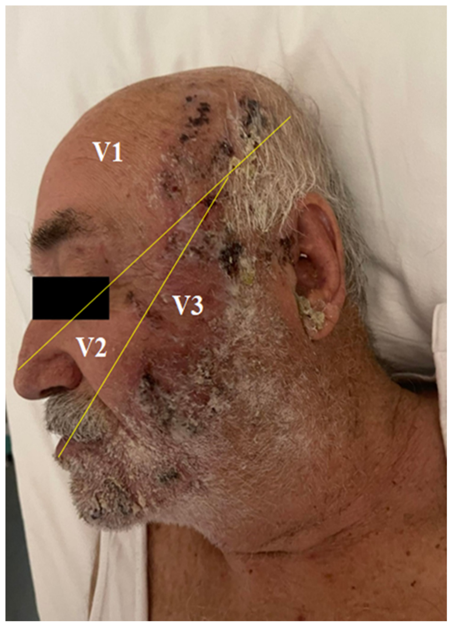 multidermatomal-herpes-zoster-involving-all-three-branches-of-the