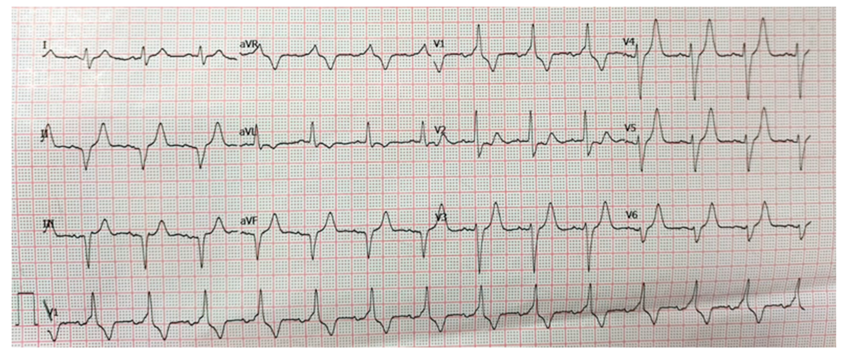Case Report: Transient Complete Atrioventricular Block During Coronary ...