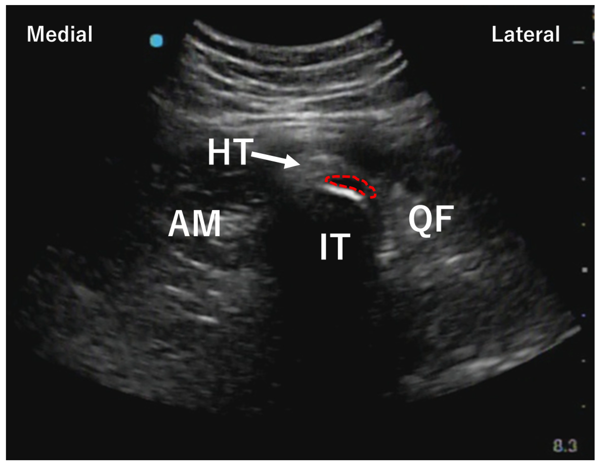 Hamstring Gluoro Injection Successful Treatment of Hamstring Tendinopathy in a Nonathlete with ...