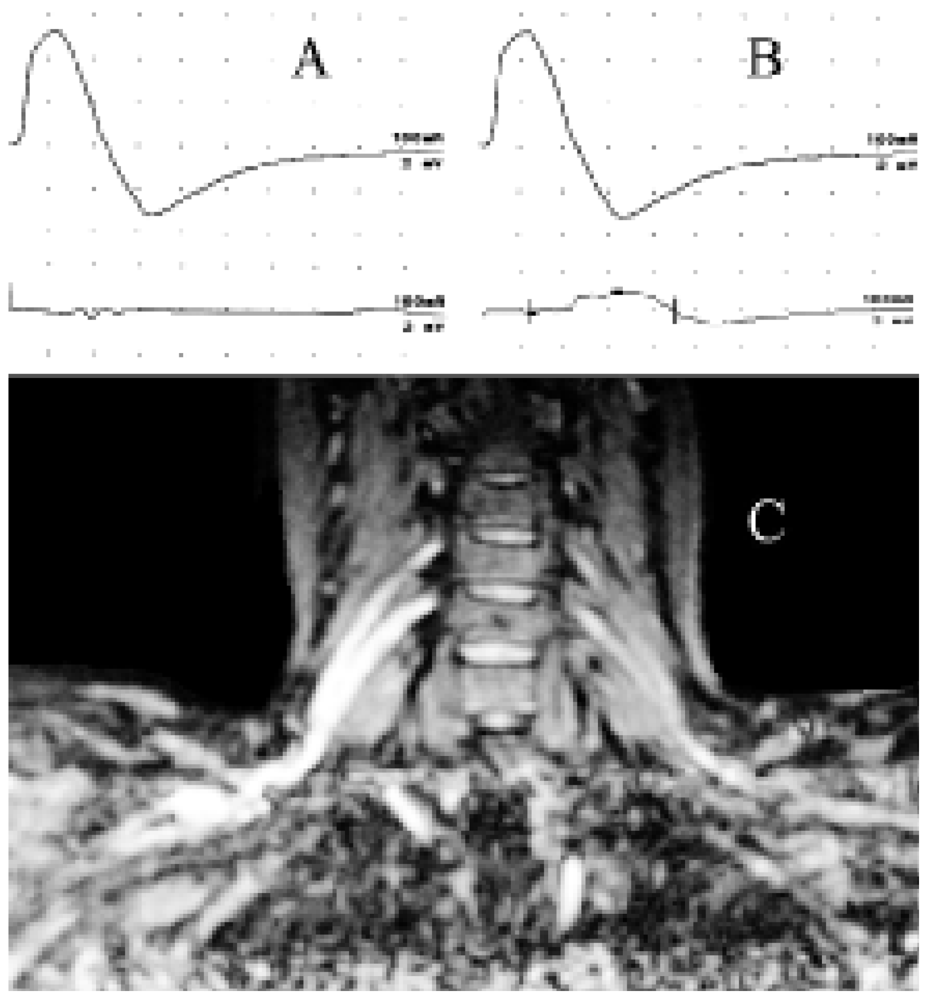 Clinical background of the multifocal motor neuropathy: the Lausanne ...