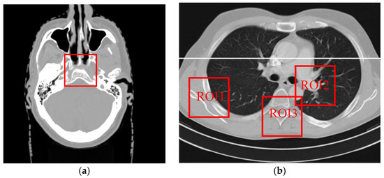Low Dose CT Image Reconstruction Based on Structure Tensor Total ...