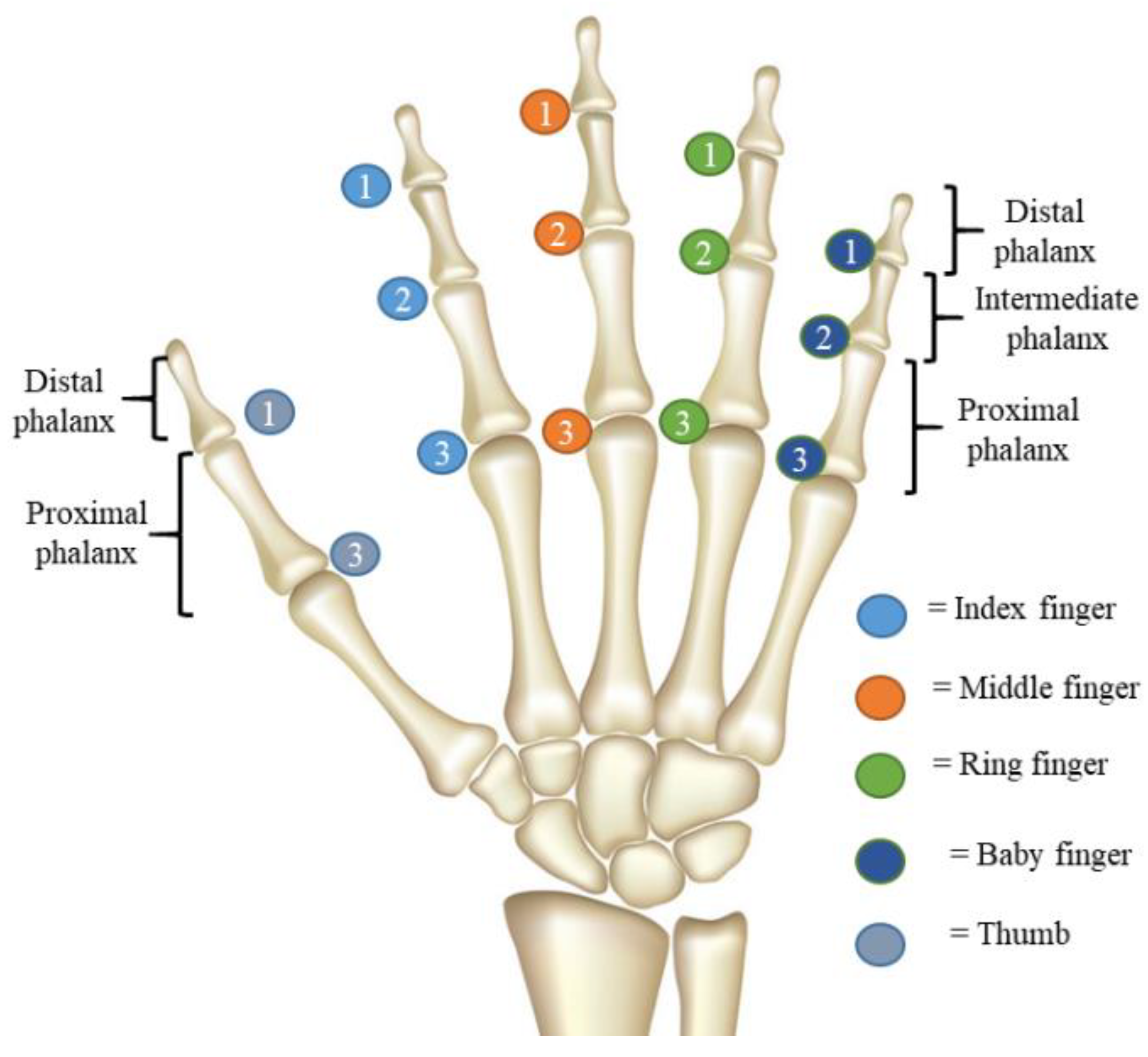 424.3 - ring finger distal phalanx fracture | ring finger di… | Flickr