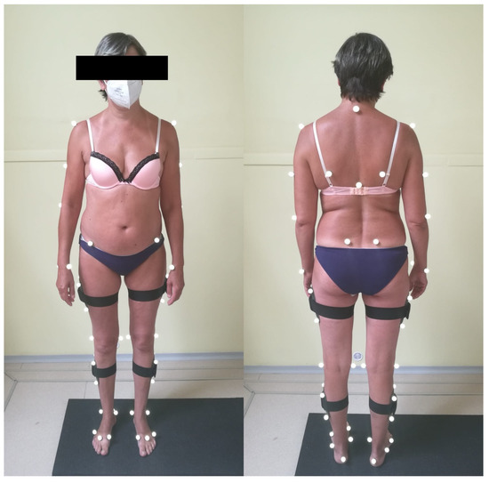 Patient 2866, Midback-Bra Line Liposuction Gallery