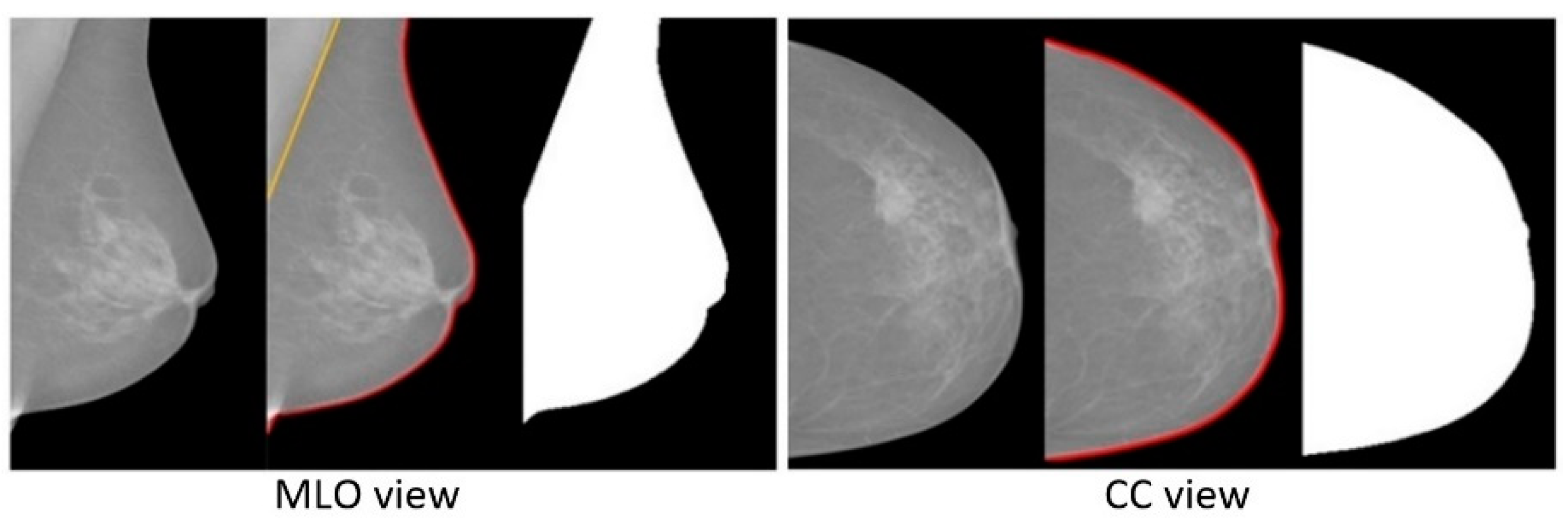 AI accurately classifies breast density •