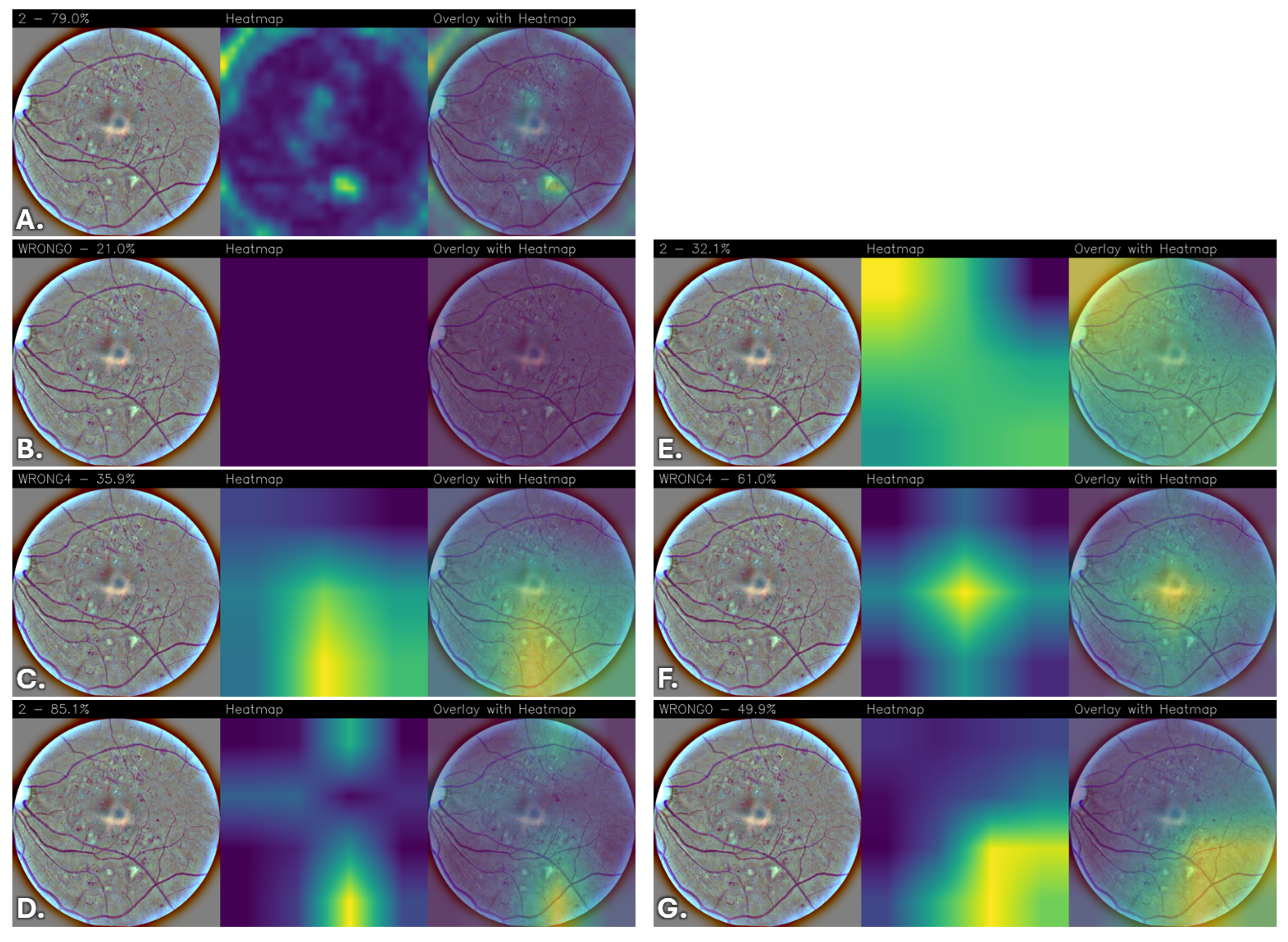 A Novel Convolutional Neural Network for Explainable Diabetic ...