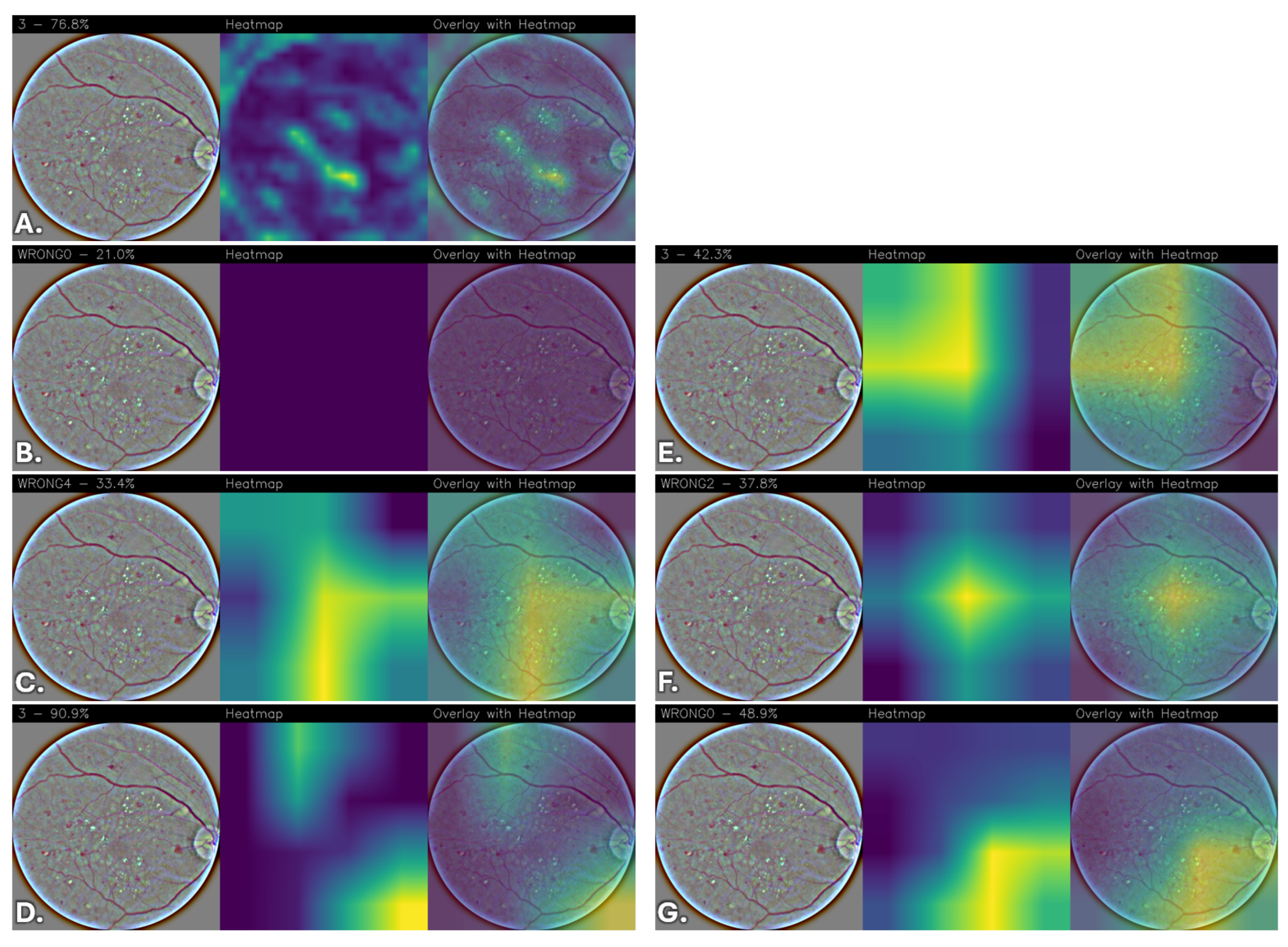 A Novel Convolutional Neural Network for Explainable Diabetic ...