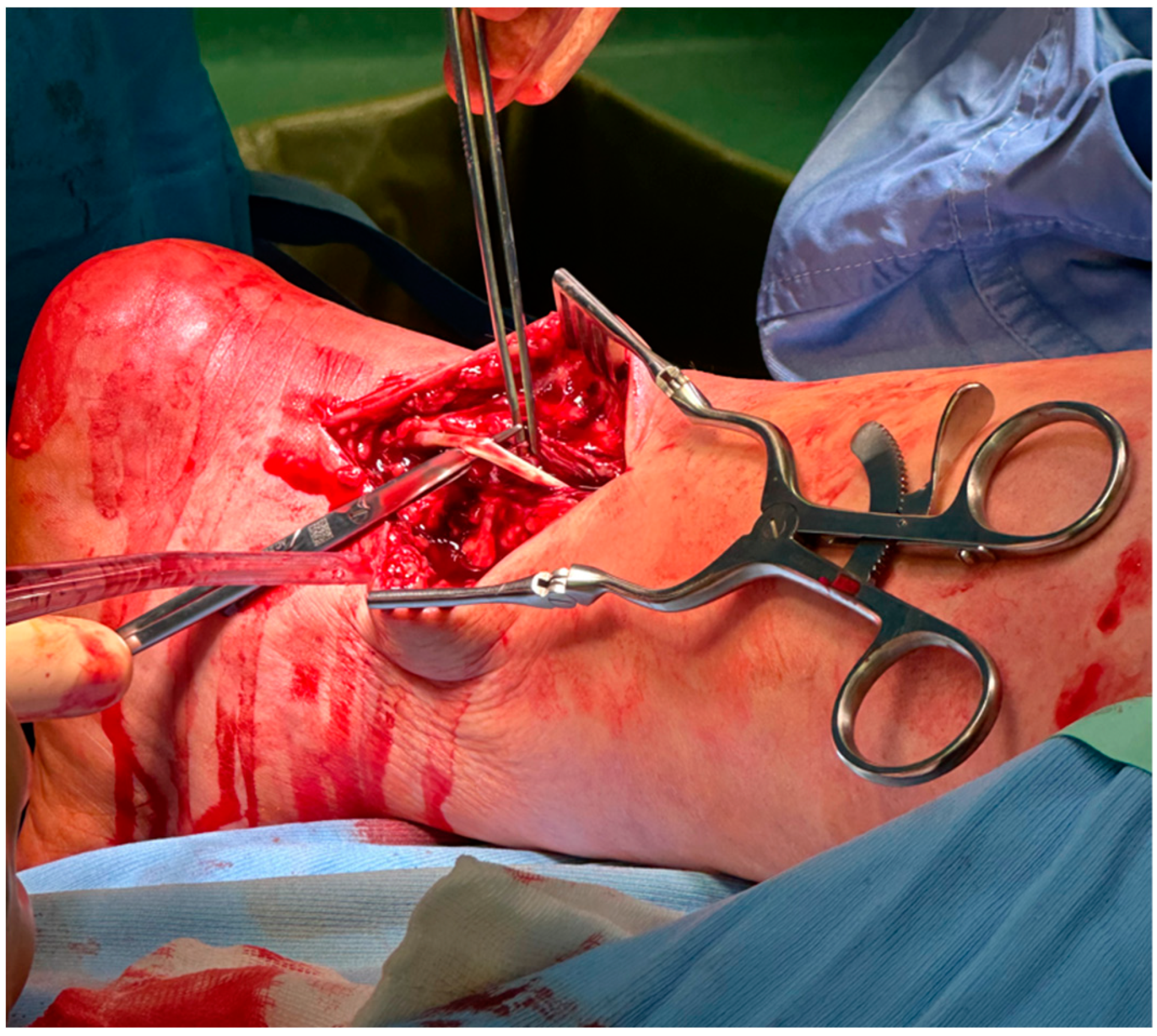 Direct Anatomical Reconstruction Of The Achilles Tendon And Its Direct Anatomical Reconstruction Of The Achilles Tendon And Its