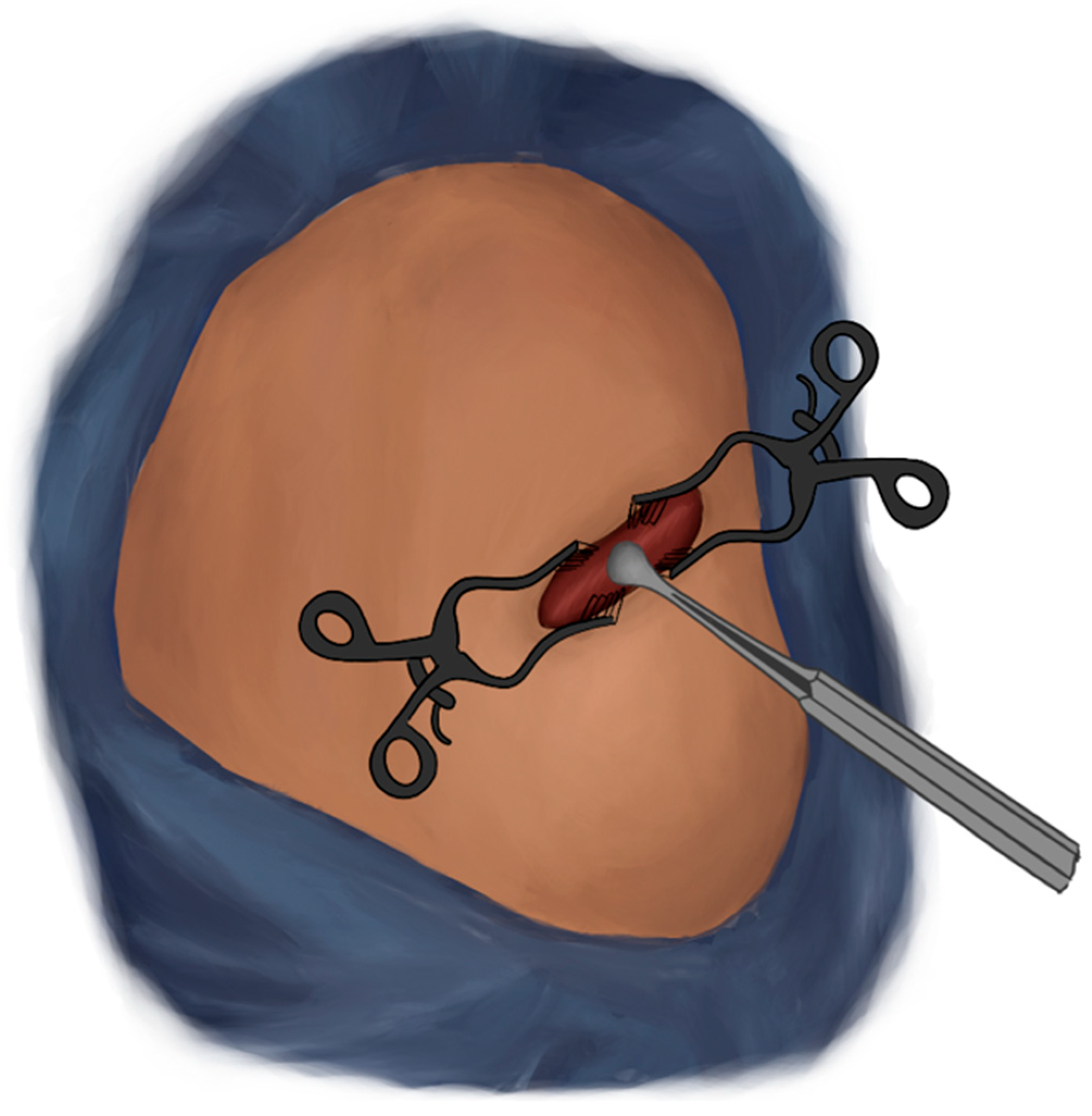 Surgical Technique for Superior Cluneal Nerve Decompression