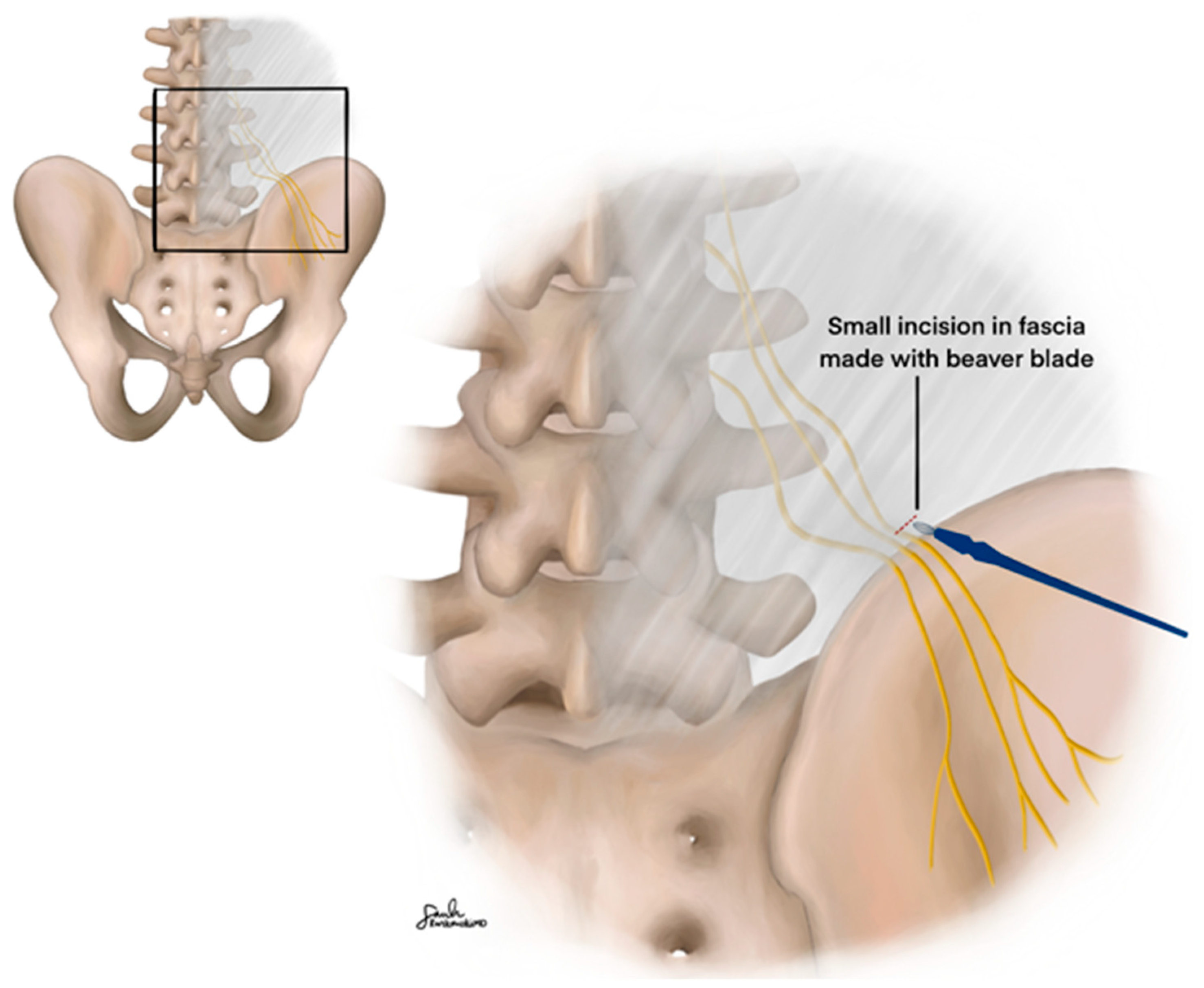 Surgical Technique for Superior Cluneal Nerve Decompression