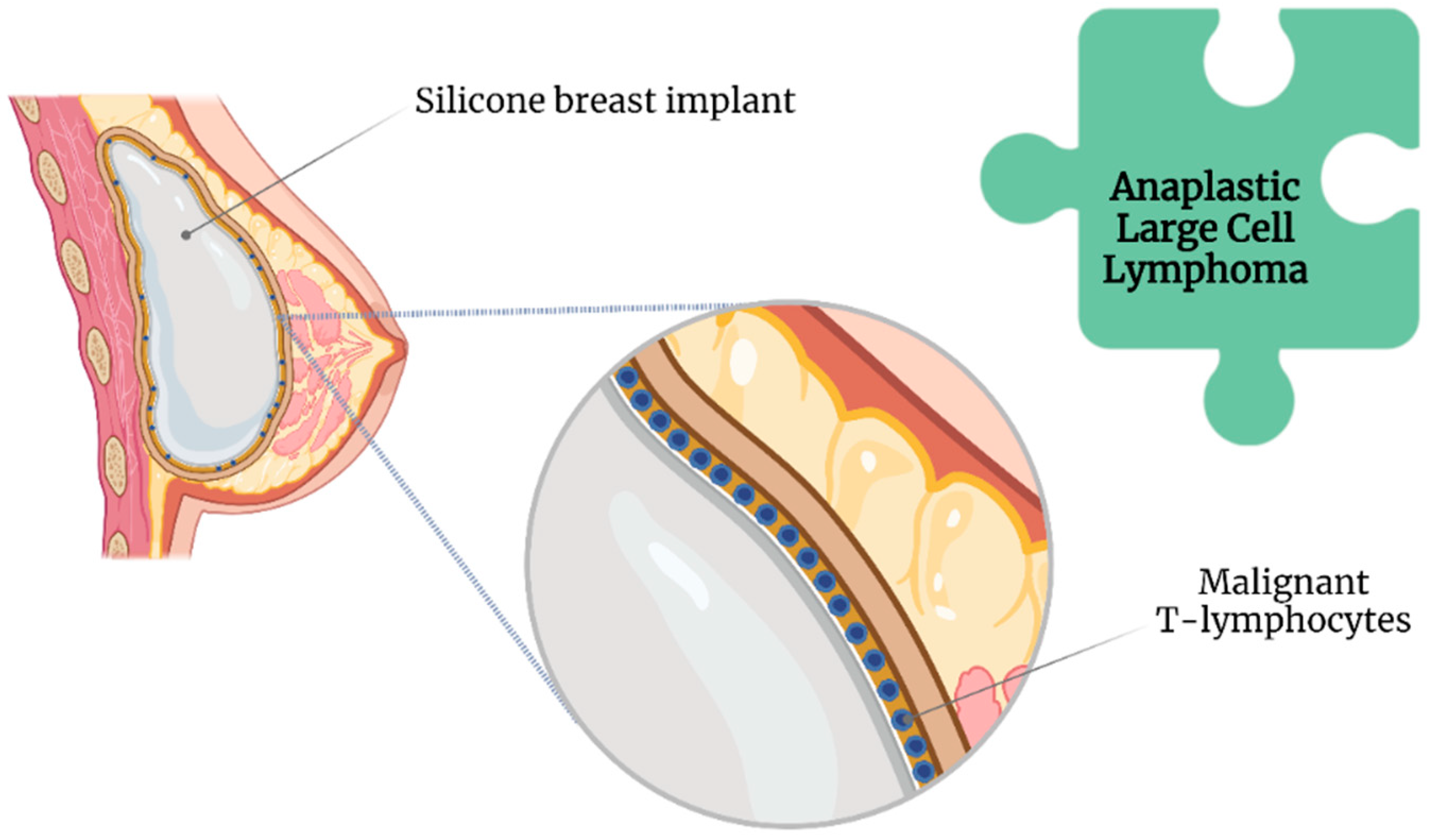 Can Breast Implants Cause Disease?