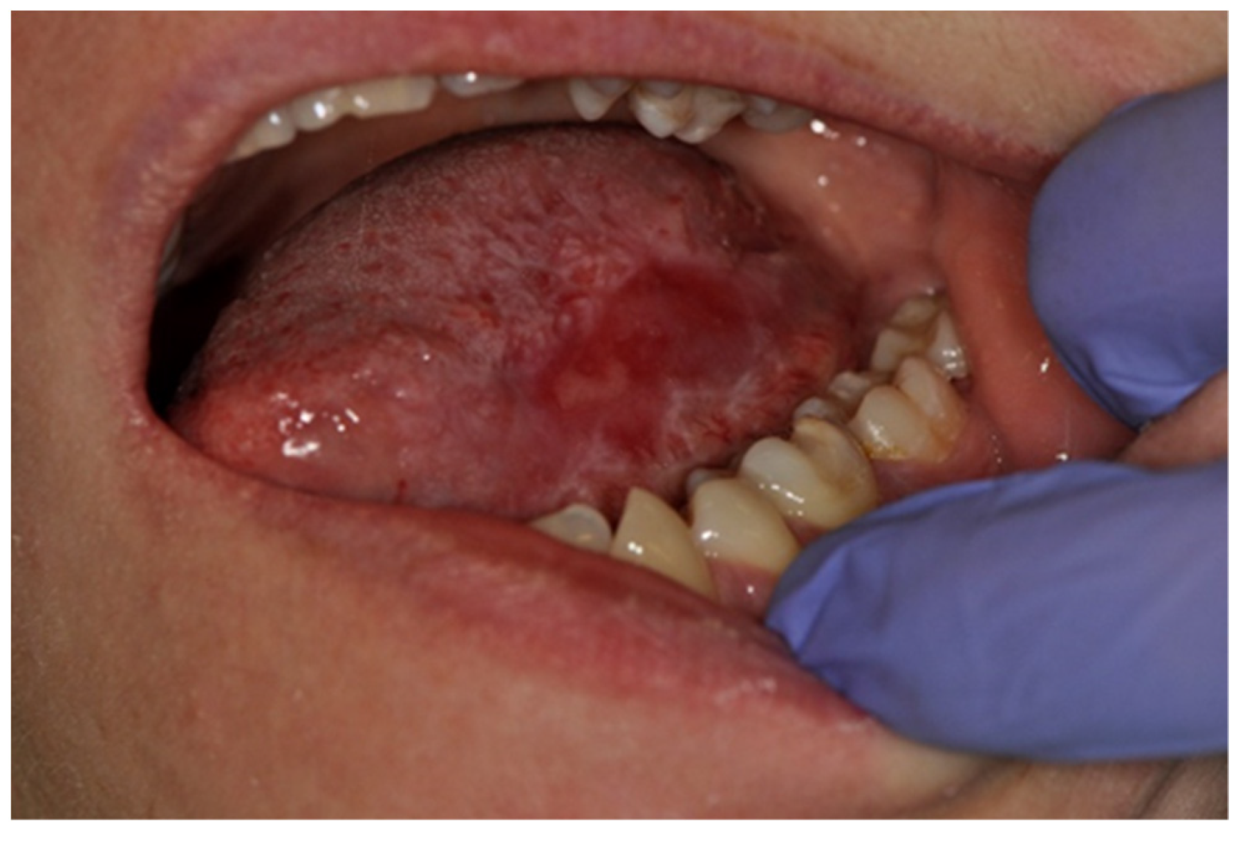 Symmetry Free Full Text Prevalence And Characteristic Of Oral Mucosa Lesions
