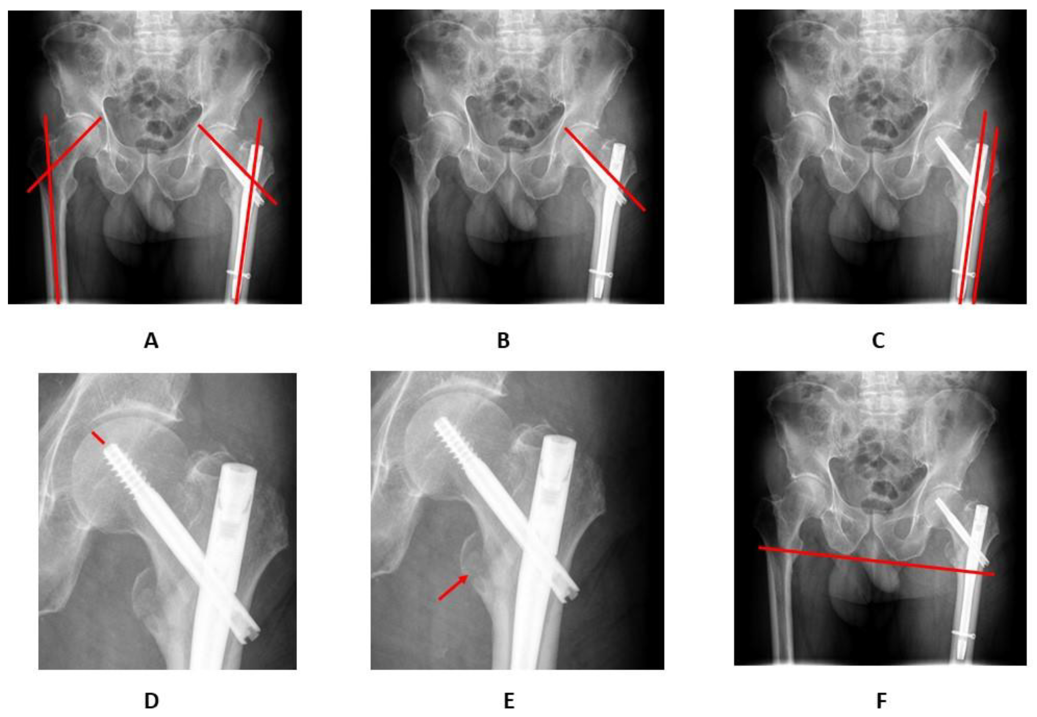 Nonoperative treatment for Simple pertrochanteric fractures with