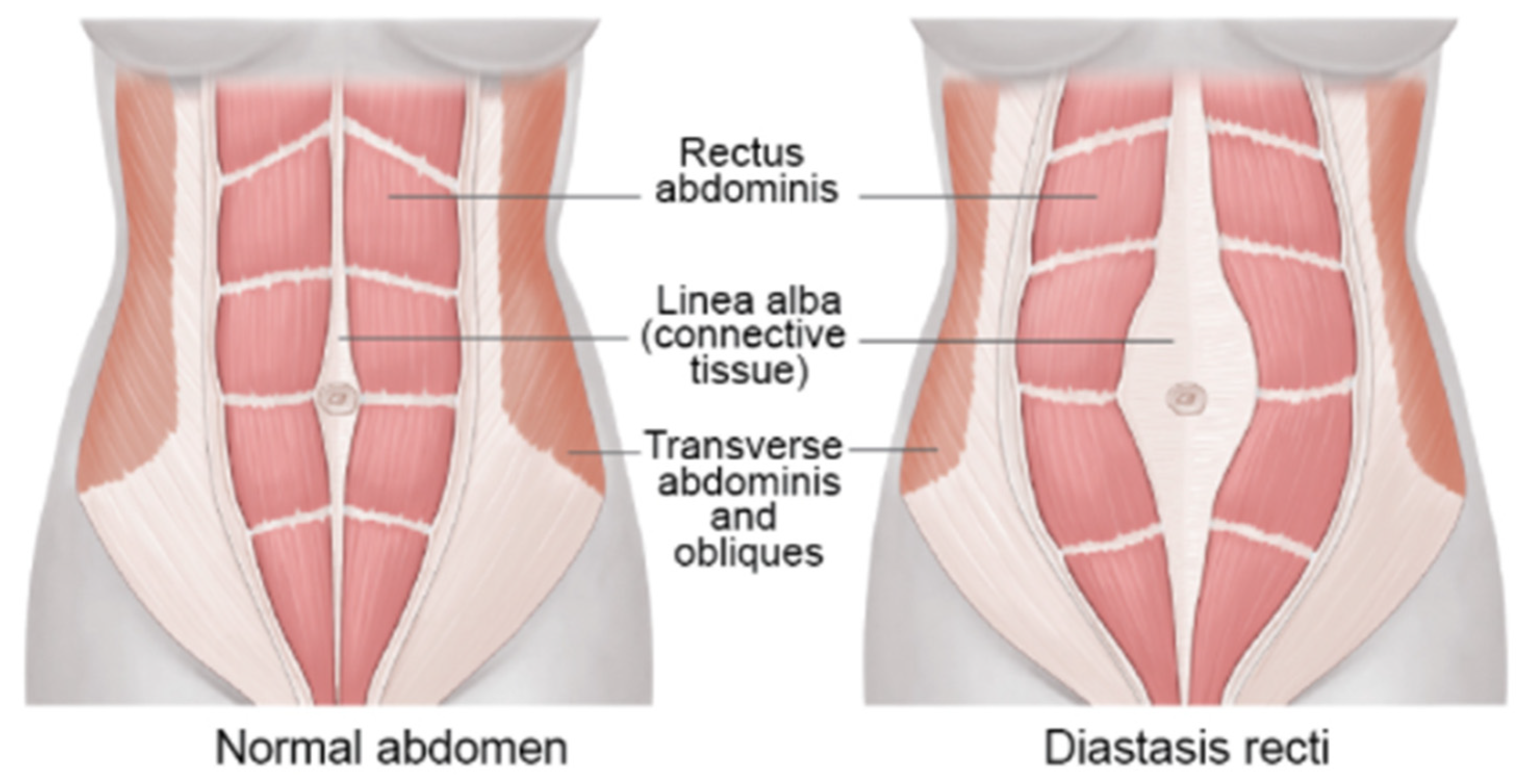 Automatic Assessment Of Abdominal Exercises For The Treatment Of Automatic Assessment Of Abdominal Exercises For The Treatment Of