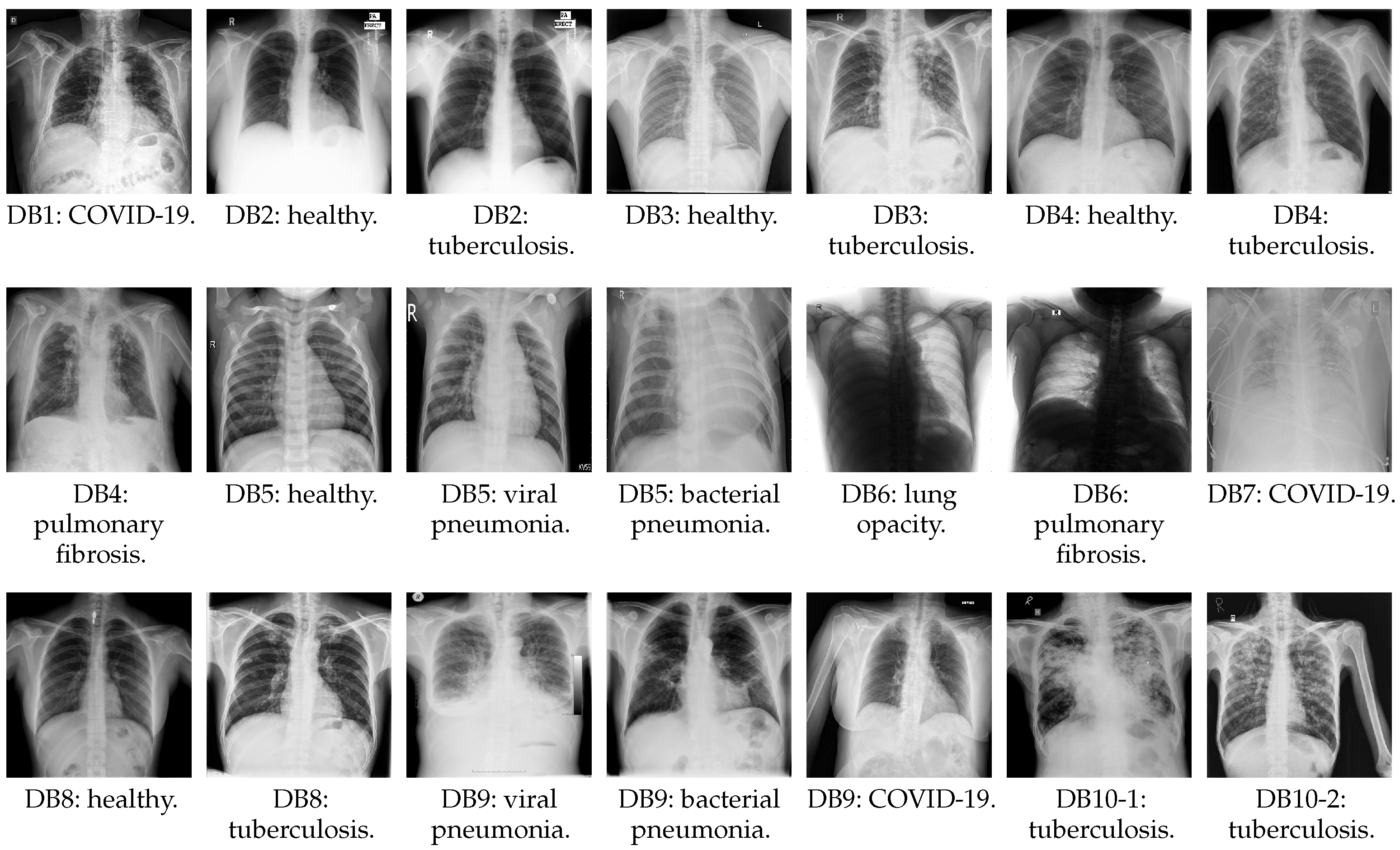 Lung Disease Classification Using Deep Learning and ROI-Based Chest X ...