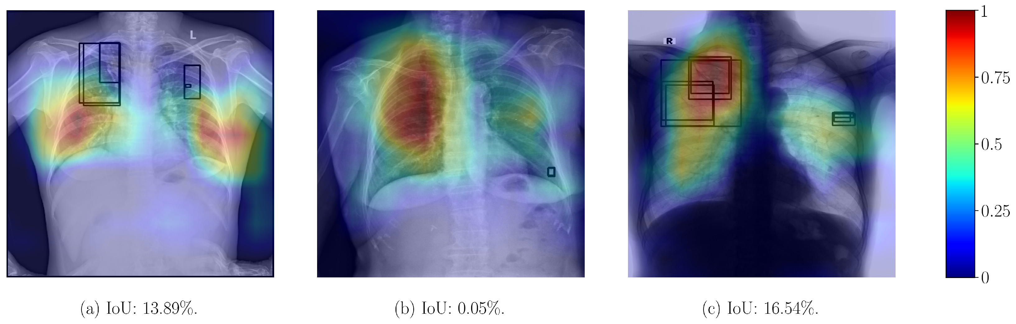 Lung Disease Classification Using Deep Learning and ROI-Based Chest X ...