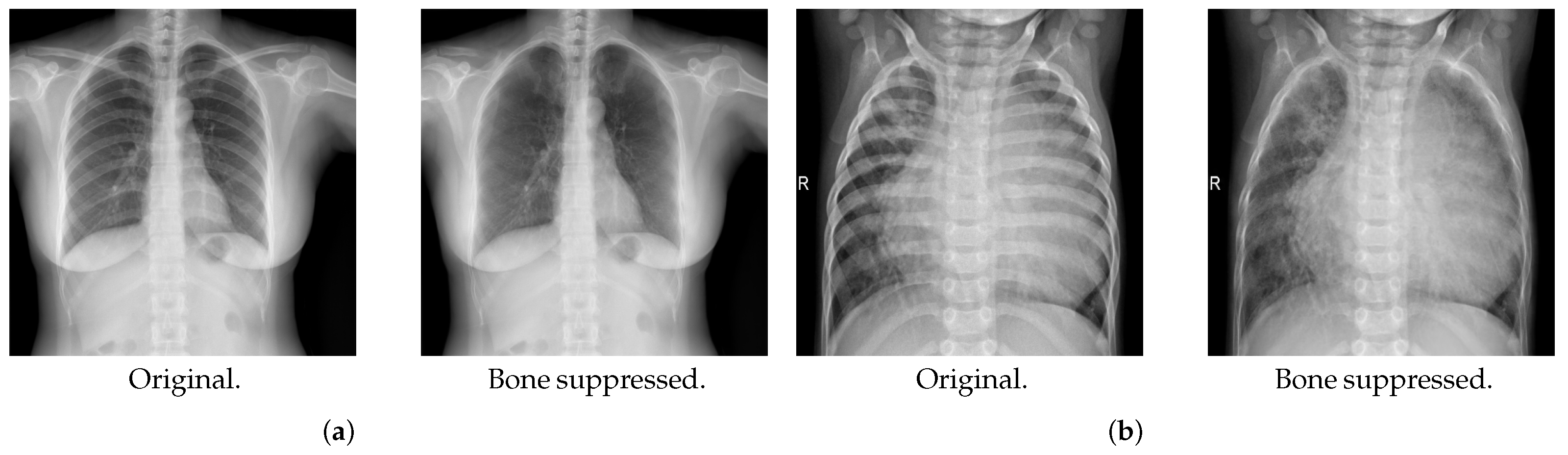 Lung Disease Classification Using Deep Learning and ROI-Based Chest X ...