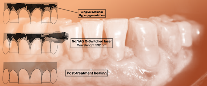 Transepithelial Gingival Depigmentation Using a New Protocol with Q-Switched Nd:YAG