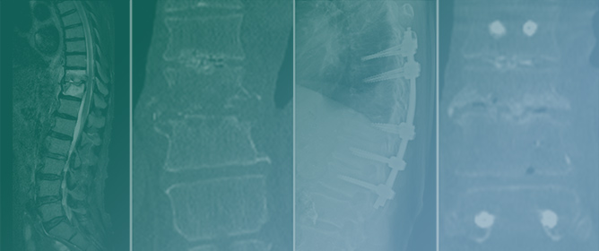 Treatment of Thoracolumbar Pyogenic Spondylitis with Minimally Invasive Posterior Fixation without Anterior Lesion Debridement or Bone Grafting: A Multicenter Case Study