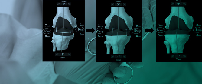 Functional Alignment Philosophy in Total Knee Arthroplasty&mdash;Rationale and Technique for the Valgus Morphotype Using an Image Based Robotic Platform and Individualized Planning
