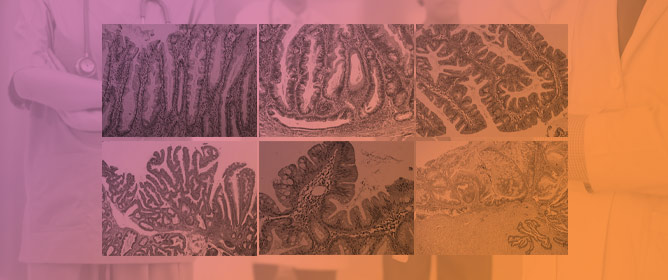 Significance of Micromorphological Characteristics and Expression of Intermediate Filament Proteins CK7 and CK20 in the Differential Diagnosis of Serrated Lesions of the Colorectum