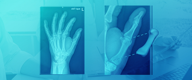 Design of Reliable Remobilisation Finger Implants with Geometry Elements of a Triple Periodic Minimal Surface Structure via Additive Manufacturing of Silicon Nitride
