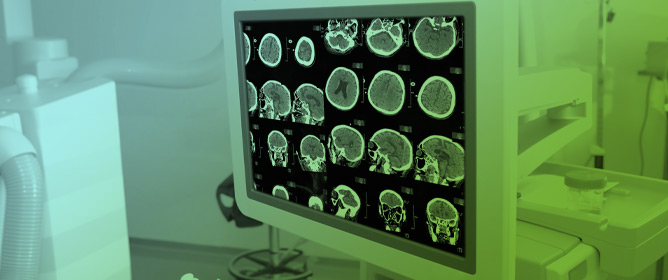 Imaging of Skull Base Tumors