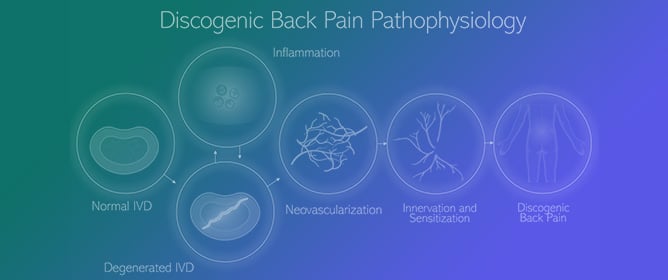 Updates on Pathophysiology of Discogenic Back Pain