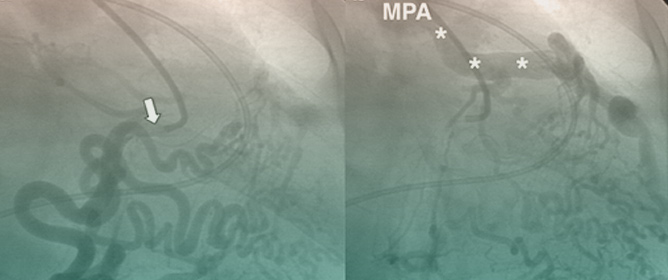 Anomalous Left Coronary Artery from the Pulmonary Artery: How to Diagnose and Treat