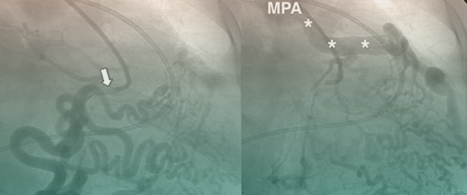 Anomalous Left Coronary Artery from the Pulmonary Artery: How to Diagnose and Treat