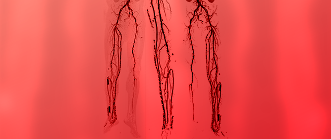 Computed Tomography Findings in Deep Vein Arterialization