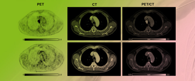 Induction of Arterial Inflammation by Immune Checkpoint Inhibitor Therapy in Lung Cancer Patients as Measured by 2-[<sup>18</sup>F]FDG Positron Emission Tomography/Computed Tomography Depends on Pre-Existing Vascular Inflammation