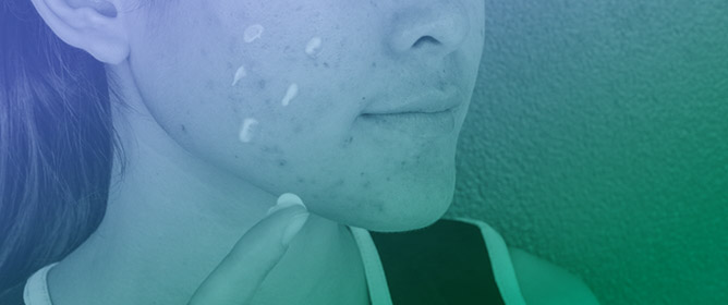 Treatment Advances for Acne Vulgaris: The Scientific Role of Cannabinoids
